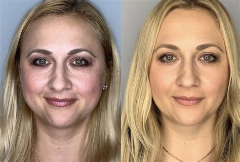 buccal fat removal 10 years later|Why You May Regret Buccal Fat Removal Later 